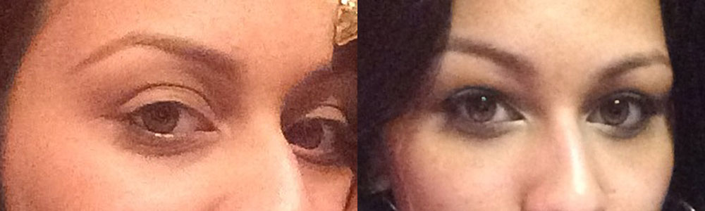 Eyelid Fat Transfer Grafting Before After Photos Los Angeles