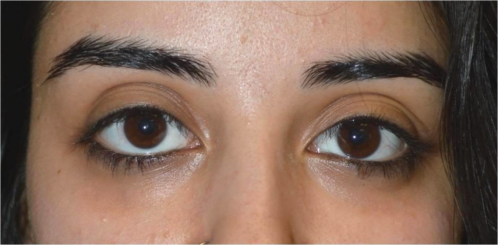 los angeles drooping lower eyelid