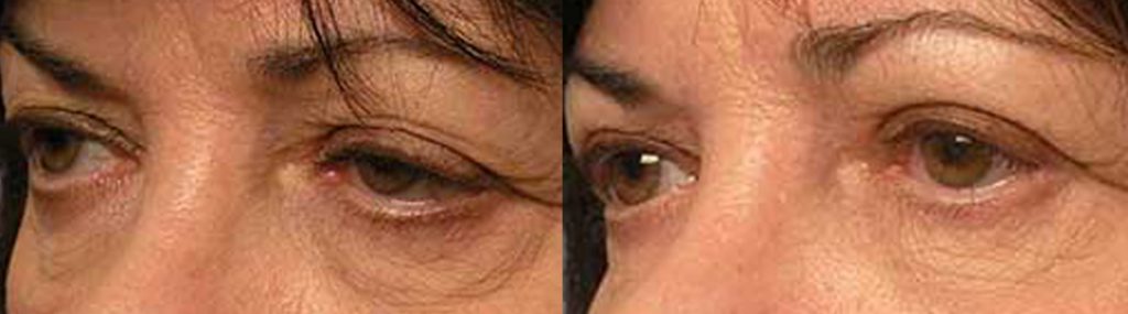 canthoplasty taban md