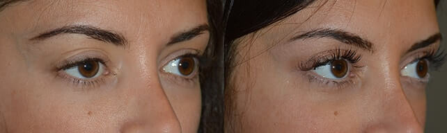 Before (left) and 3 months after (right) revisional right upper eye fold ptosis treatment.