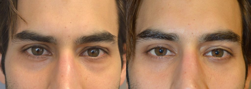 Los Angeles Lower Eyelid Bag Treatment