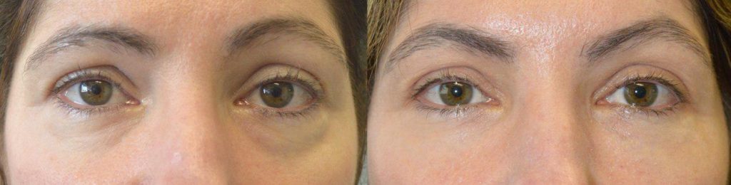 Beverly Hills Non-Surgical Tired Eyes Treatment