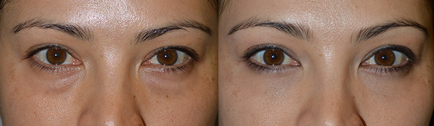 Beverly Hills Dark Circles Correction