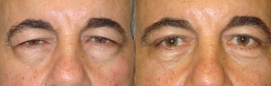 Why Droopy Eyelid Surgery Is About More Than Aesthetics Taban Md