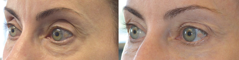 Beverly Hills Cosmetic Eye Rejuvenation