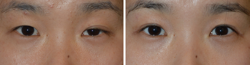 Taban-blepharoplasty-asymmetry-upper-lid