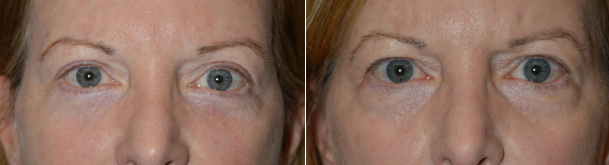 Upper Blepharoplasty