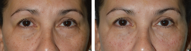 LA Dermal Filler