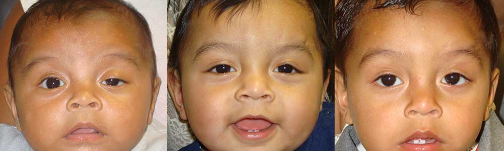 Congenital Ptosis Treatment LA