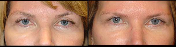 Droopy Eyelid Treatmetns in Los Angeles