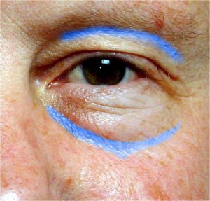 Eyeid Filler