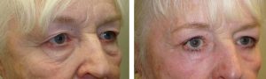 Upper Blepharoplasty