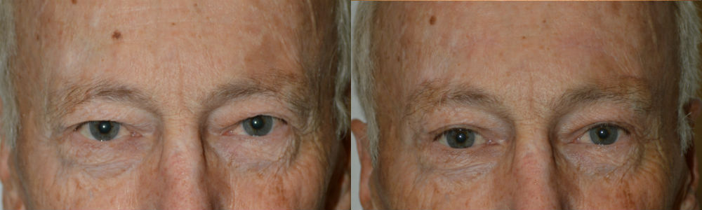 Correct cosmetic effects of drooping upper eyelids