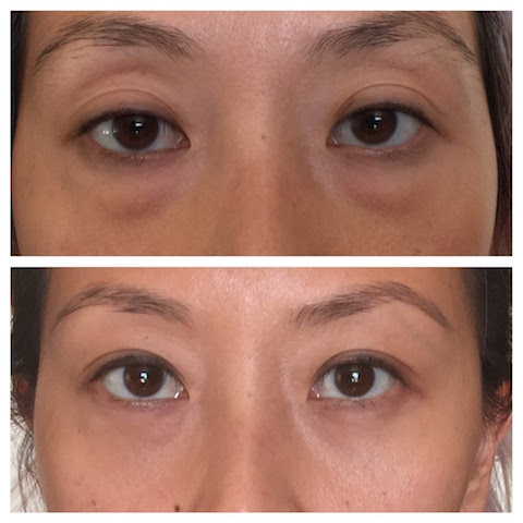 Lower eyelid bags transconjunctival lower blepharoplasty