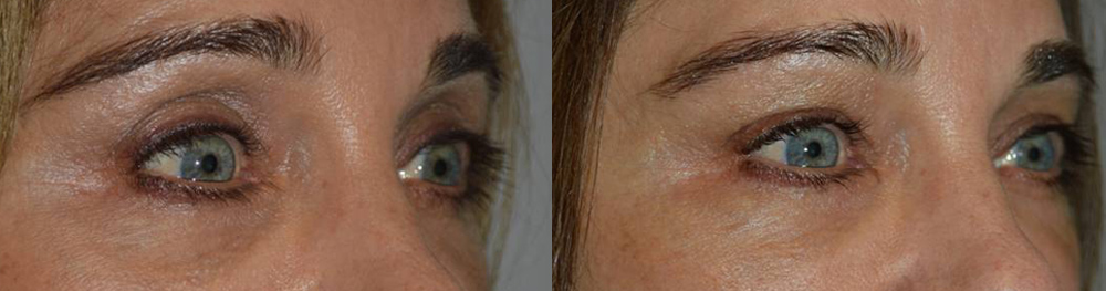 seeing spots before your eyes after surgery