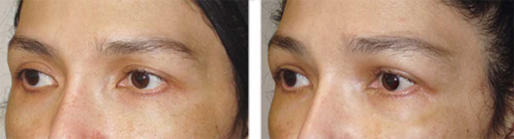 Young female, with mild to moderate upper eyelid hollowness, desired more fullness. She chose to have fat injection (instead of filler injection) in the upper eyelids and sub-brow area. Before and 3 months after eyelid fat transfer photos are shown. Note more youthFUL upper eyelid results.