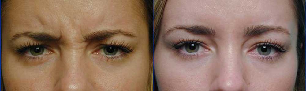 Young female, with frown lines, received botulinum toxin (Botox) injection with resolution of the frown lines in natural way. Before (left) and 1 week after Botox treatment (right) photos are shown.