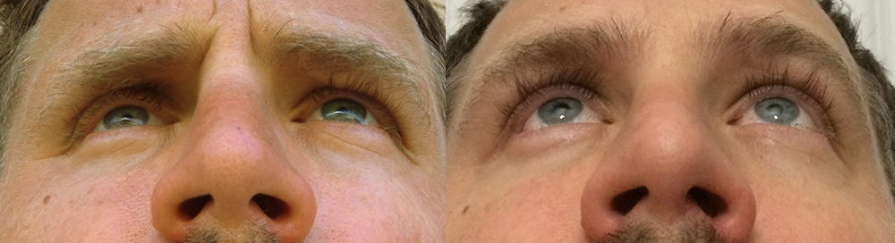 Before (left) 40 year old male, with history of multiple large orbital fractures, with significant enophthalmos (sunken eye) and cheek fracture with sunken cheek. After (right) 4 months after right orbital fracture surgery, enophthalmos (sunken eye) surgery with orbital floor implant, and cheek implant.