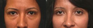 Celebrities Who Have Undergone Blepharoplasty | Taban MD
