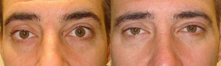 Upper Eyelid Retraction Before After Photos Taban Md Oculoplastic Cosmetic Eyelid Plastic 1595