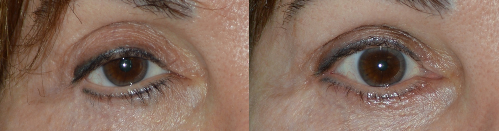 Beverly Hills Fat Grafting Eyelid Lift