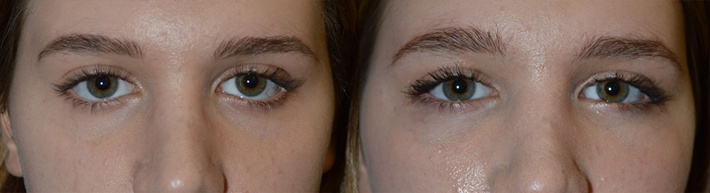 Before and After Lower Eyelid Retraction Surgery