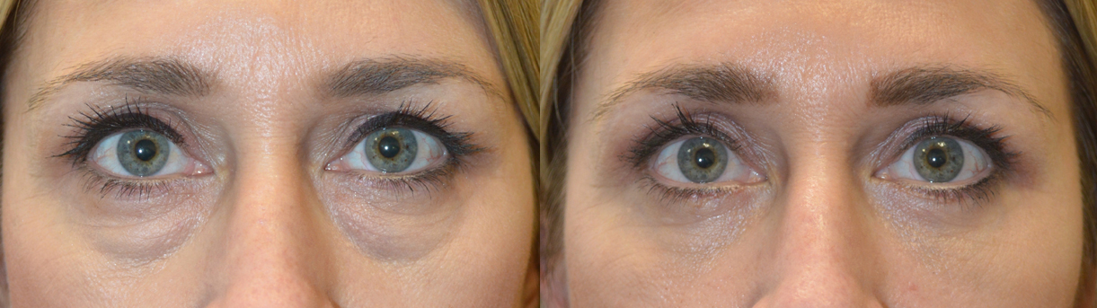 47 year old female, c/o under eye bags and saggy upper lids, looking tired. She underwent transconjunctival lower blepharoplasty with fat bags repositioning and skin pinch plus upper blepharoplasty, under local anesthesia with oral sedation in the office. Before and 6 weeks after cosmetic Quad-blepharoplasty photos are shown.