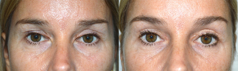 Eyelid Revision Surgery Beverly Hills Revision Blepharoplasty 9681