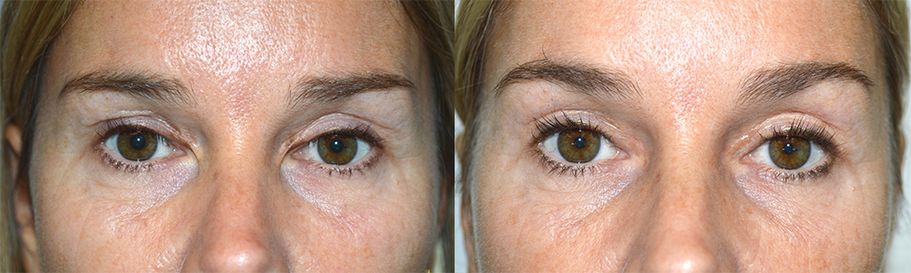 This patient suffered from severe eyelid scarring in the medial canthus from previous blepharoplasty with canthal web. She underwent revision eyelid scar surgery with epicanthoplasty. Preoperative and 3 months postoperative photos are shown.