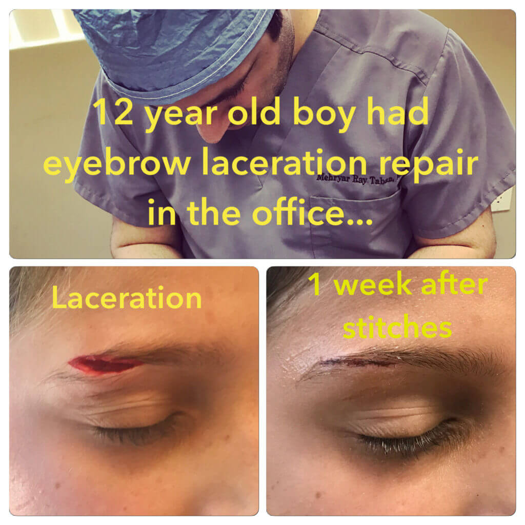 Eyelid Laceration Surgery by Beverly Hills Plastic Surgeon