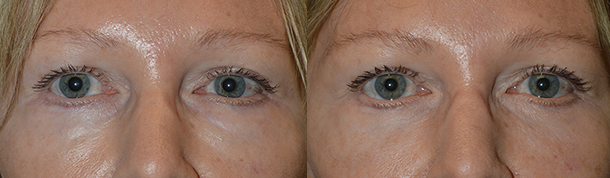 Beverly Hills Lower Eyelid Filler Eyelift