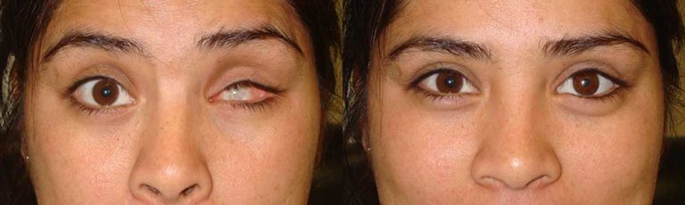 Modern Advancements in Prosthetic Eye Creation with Dr. Taban