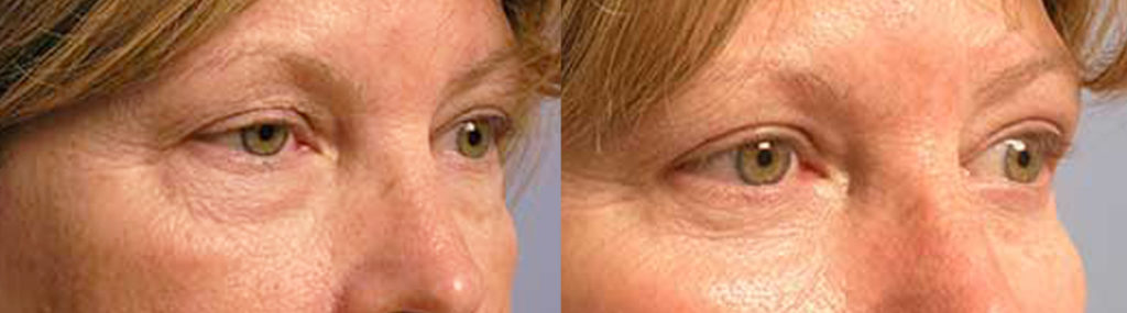 Santa Barbara Aesthetic Eye Surgery Procedure