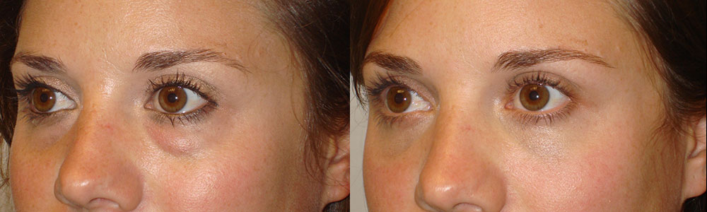 Los Angeles Blepharoplasty Facial Rejuvenation Treatment