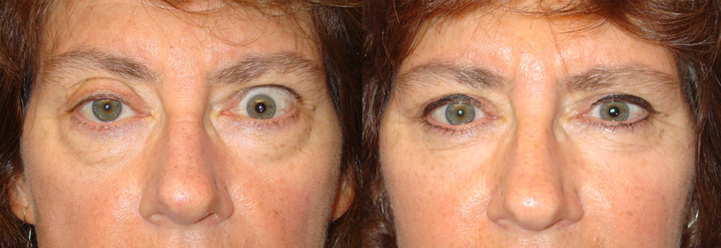 Before obvious eye asymmetry due to left upper eyelid retraction and right upper eyelid ptosis. After left upper eyelid retraction surgery and right upper eyelid ptosis surgery with improved symmetry. Los Angeles Oculoplastic Surgery Procedure