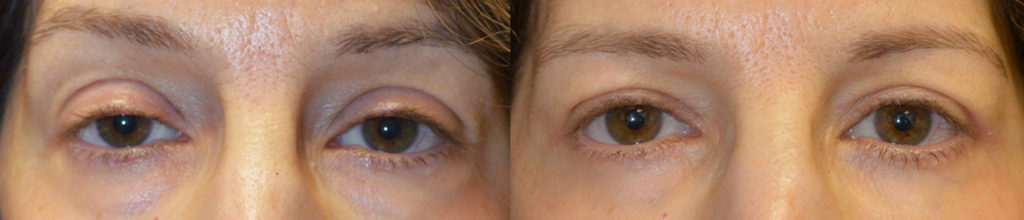 Los Angeles Oculoplastic Blepharoplasty