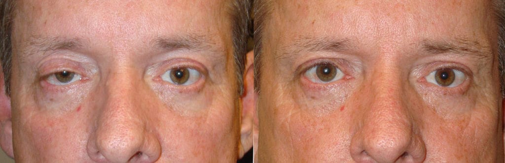 Before eye asymmetry due to right upper eyelid ptosis. After right upper eyelid ptosis surgery with improved eye symmetry. eye asymmetry right upper eyelid ptosis upper eyelid ptosis surgery eye symmetry.
