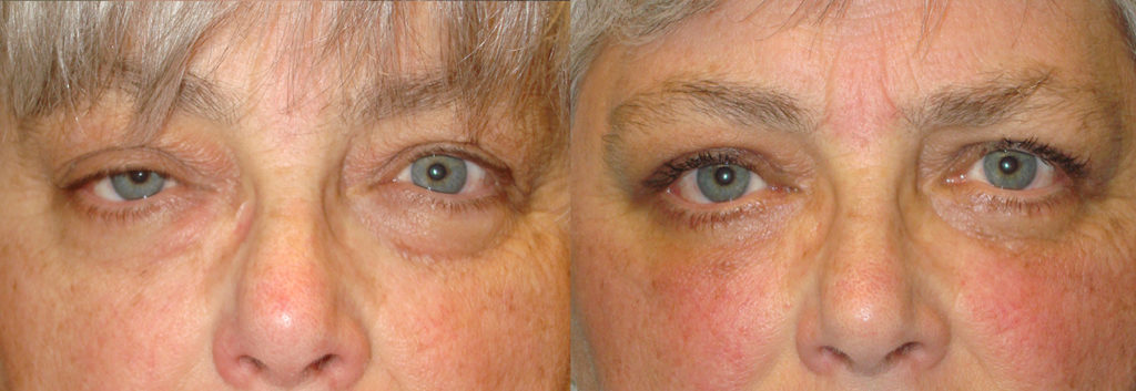 Before eye asymmetry right upper eyelid ptosis. After right upper eyelid ptosis repair with improved eye symmetry. eye asymmetry right upper eyelid ptosis upper eyelid ptosis repair with improved eye symmetry.