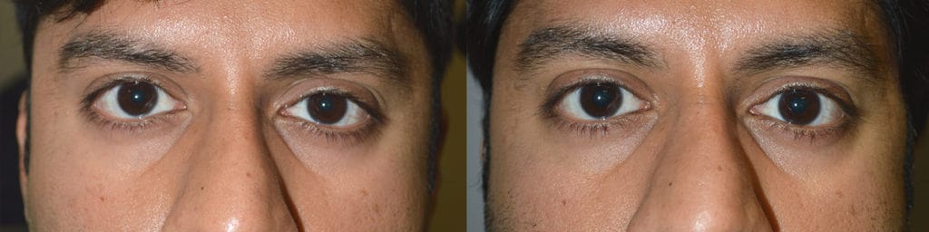 Before eye asymmetry due to mild right upper eyelid retraction. After right upper eyelid retraction surgery with improved eye symmetry. Los Angeles Crooked Eyelid Procedure upper eyelid retraction surgery