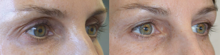 Los Angeles Non-Surgical Dark Circles