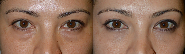 Los Angeles Under Eye Bags Injections