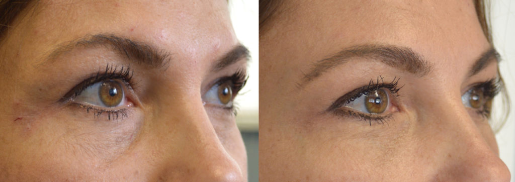 Los Angeles Dermal Filler Under Eyes