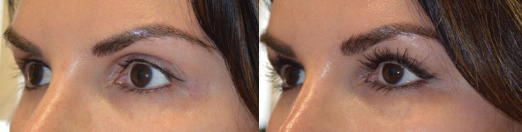 Los Angeles Oculoplastic Eyelid Injectables