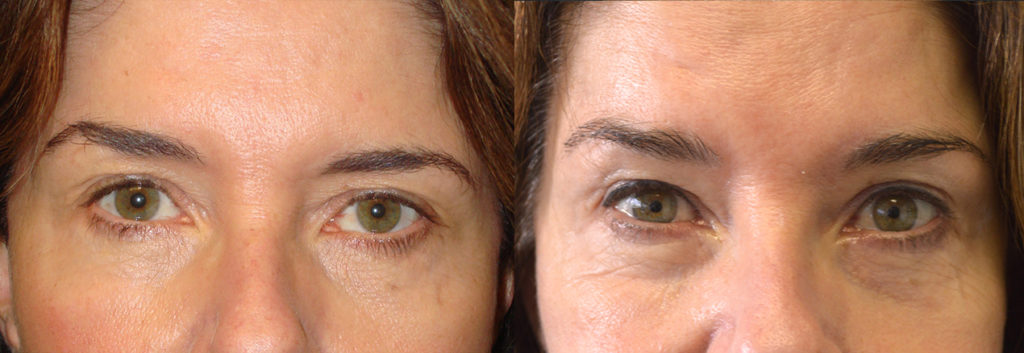 Before eye asymmetry due to uneven eyebrows with right side higher. After asymmetric botox injection to make brows evener. Los Angeles Uneven Brows Surgical Procedure