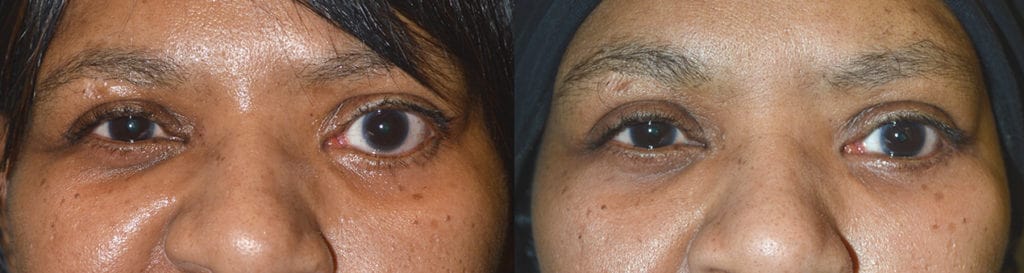 Before obvious eye asymmetry due to severe left lower eyelid retraction. After left lower eyelid retraction with improved eye symmetry. Los Angeles Lower Eyelid Procedure