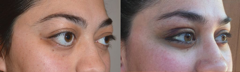 Eye asymmetry due to bulging eyes, right side worse. After bilateral orbital decompression, right side more, and lower eyelid retraction. Santa Barbara Bulging Eye Droopy eyelids eye asymmetry