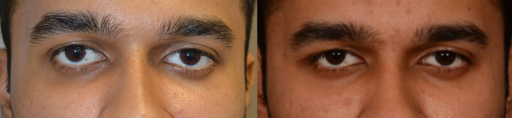 Eye asymmetry due to right eyeball higher than the left. After right customized orbital decompression to lower right eyeball, with improved eye symmetry. Santa Barbara Droopy Bulging Eyes Before After eye asymmetry