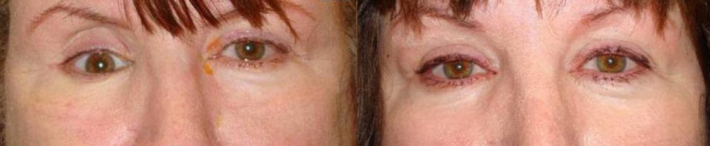 Obvious eye asymmetry due to the right sunken eye. After right orbital implant placement with improved eye. Beverly Hills Eye Asymmetry Professional