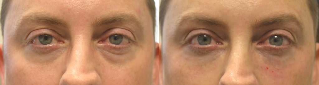 Los Angeles Injectable Eyelid Filler