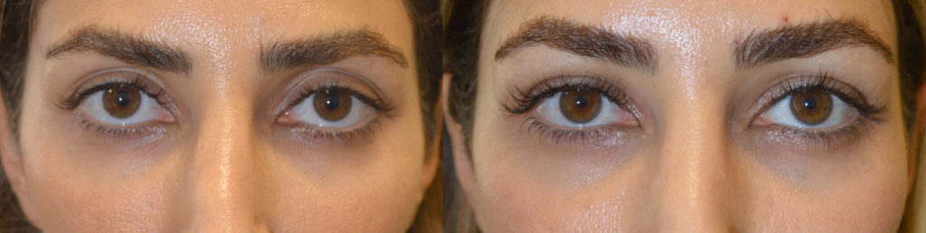 Beverly Hills Injectable Eye Enhancement